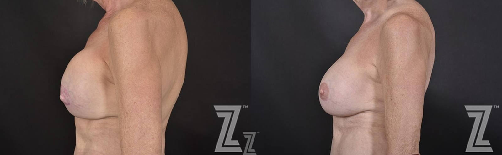 Austin Breast Reconstruction Before & After Gallery - Patient 132886765 - Image 3 - The Piazza Center