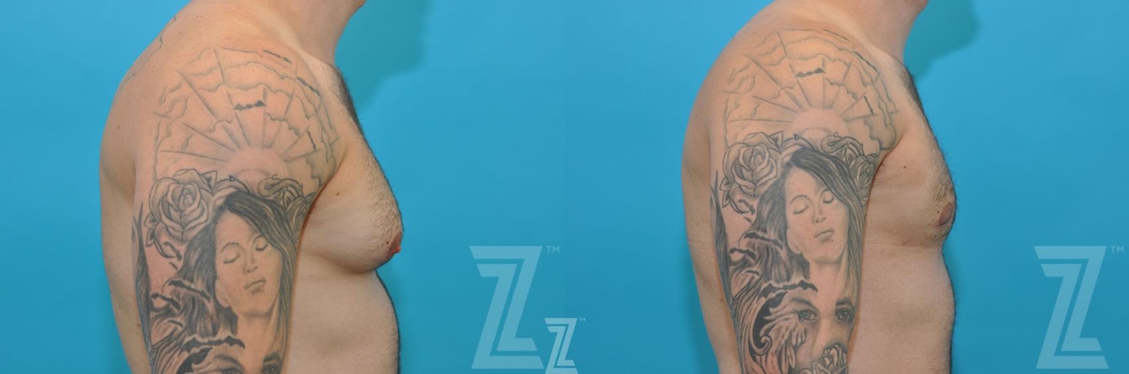 Austin Gynecomastia/Male Breast Reduction Before & After Gallery - Patient 118963 - Image 5 - The Piazza Center