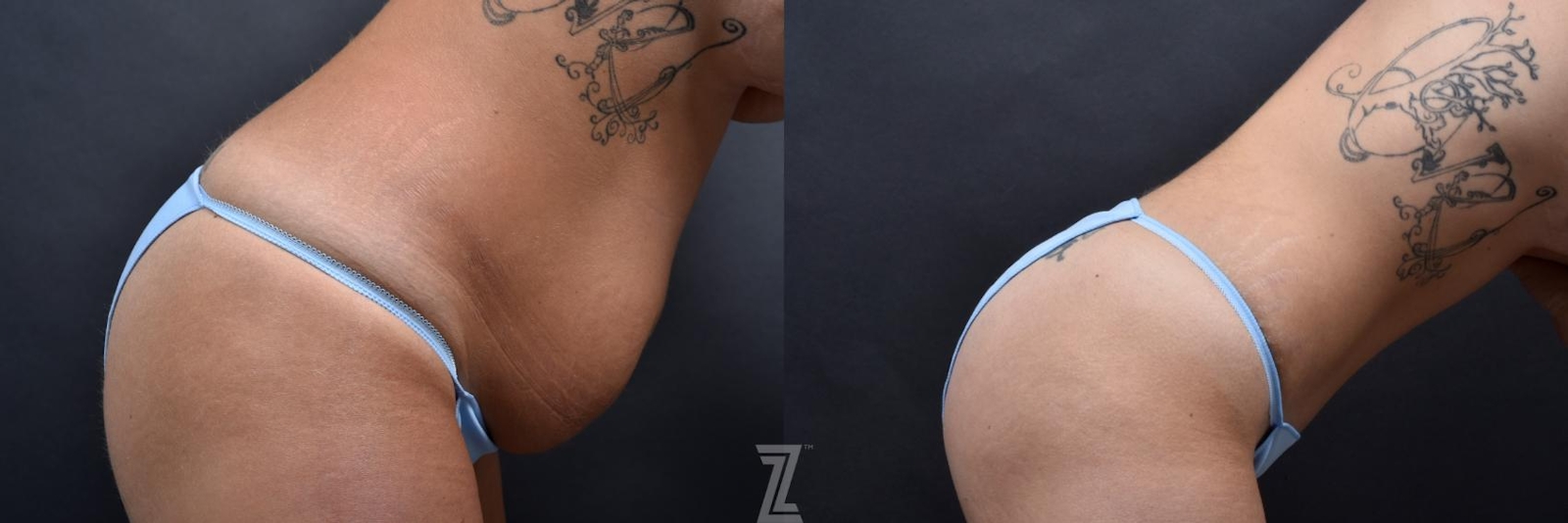 Austin Tummy Tuck Before & After Gallery - Patient 132886801 - Image 5 - The Piazza Center