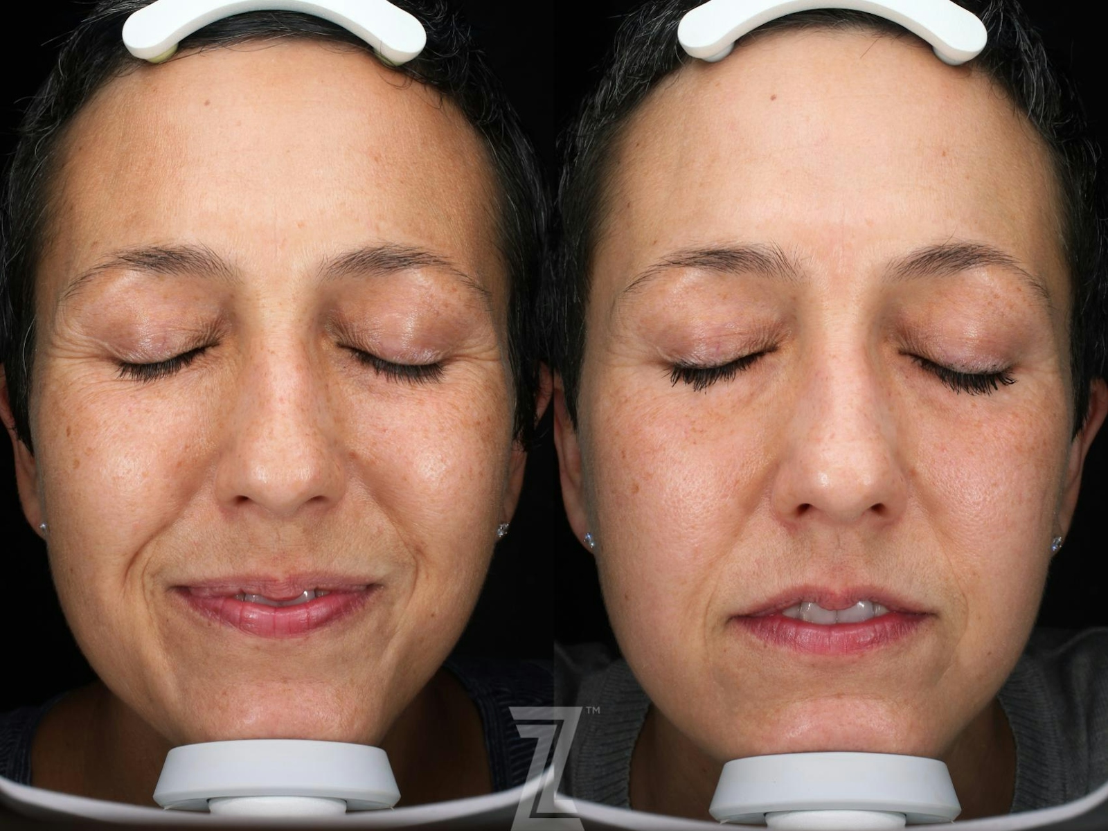 Austin Visia Skincare Analysis Before & After Gallery - Patient 132963273 - Image 1 - The Piazza Center