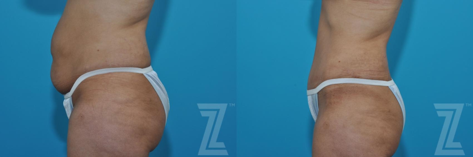 Austin Tummy Tuck Before & After Gallery - Patient 132886901 - Image 2 - The Piazza Center