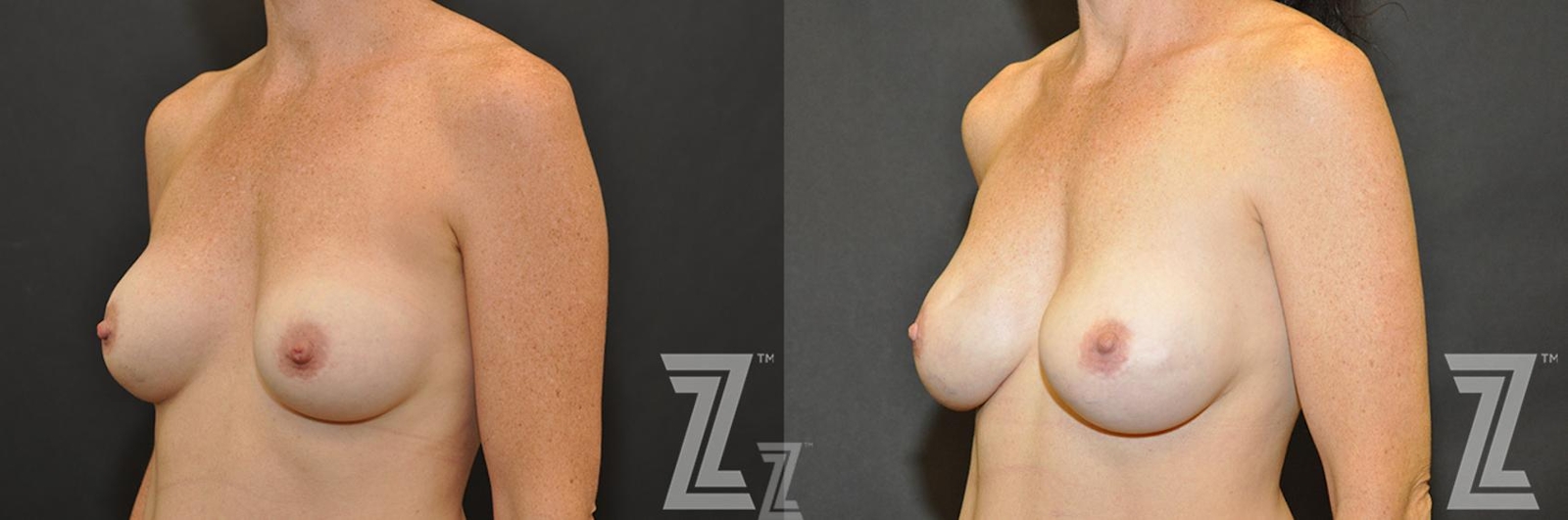 Austin Breast Reconstruction Before & After Gallery - Patient 132886773 - Image 2 - The Piazza Center