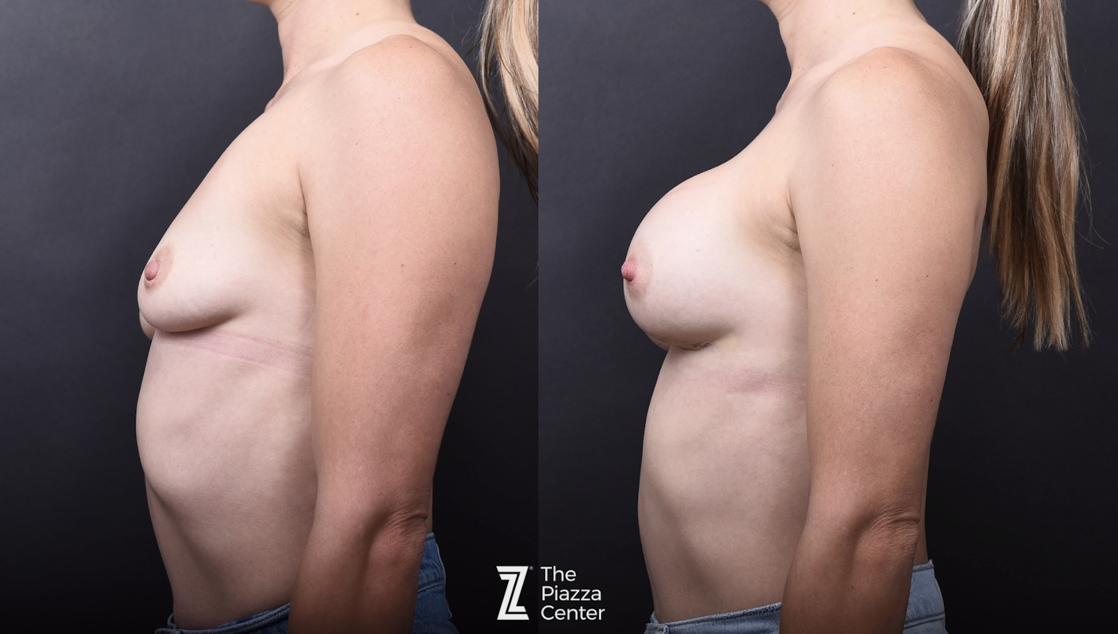 Austin Breast Augmentation Side Comparison - The Piazza Center