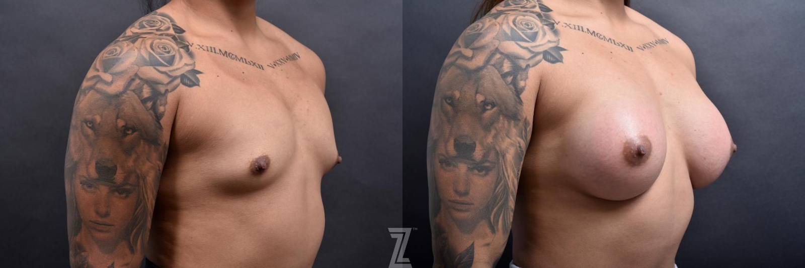 Austin oblique view of before and after image 3 month post op 25 year old woman with Silicone Implants with Cohesive Silicone Gel - The Piazza Center