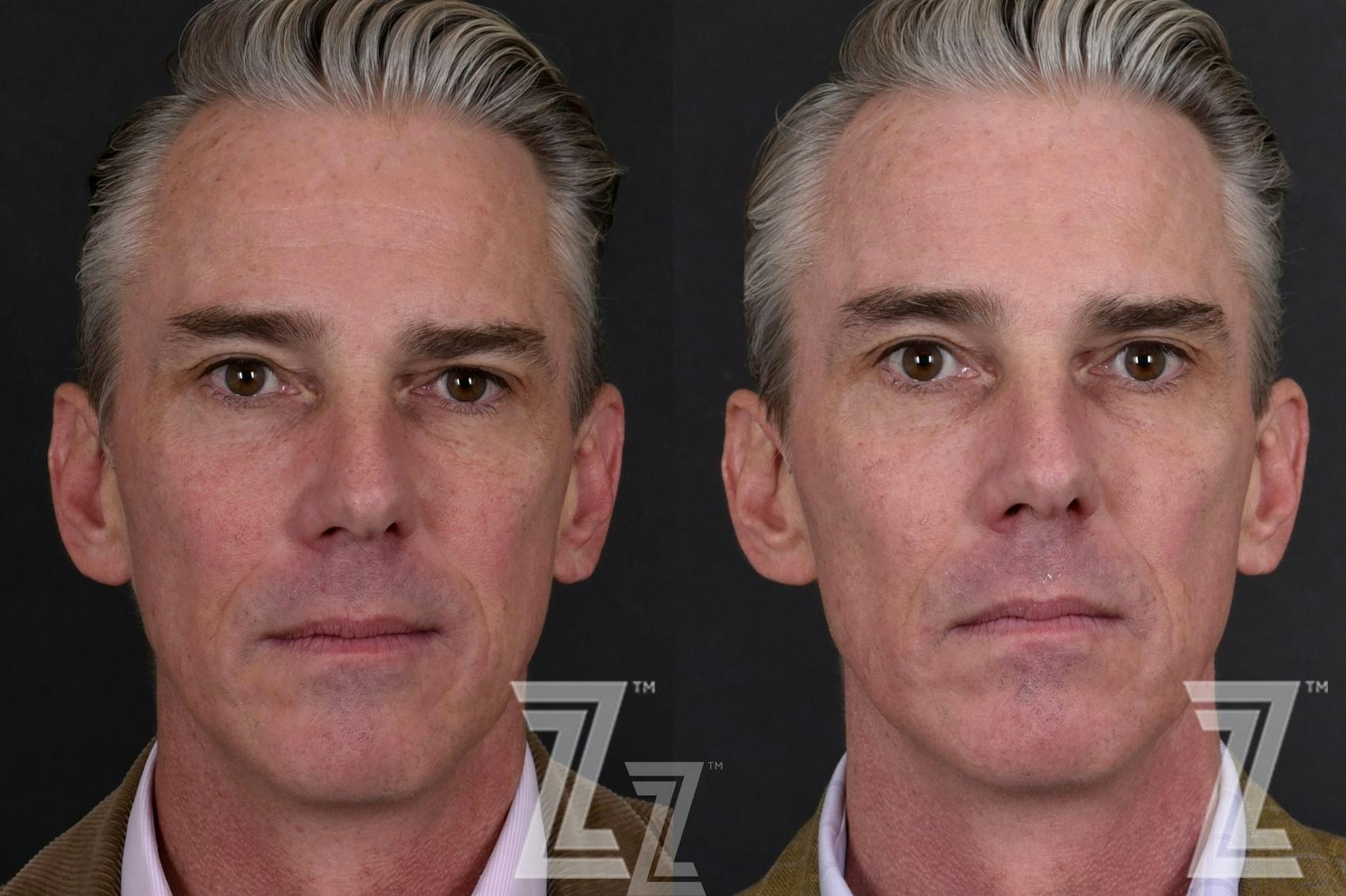 Austin Male Skin Treatments Before & After Gallery - Patient 336028 - Image 1 - The Piazza Center