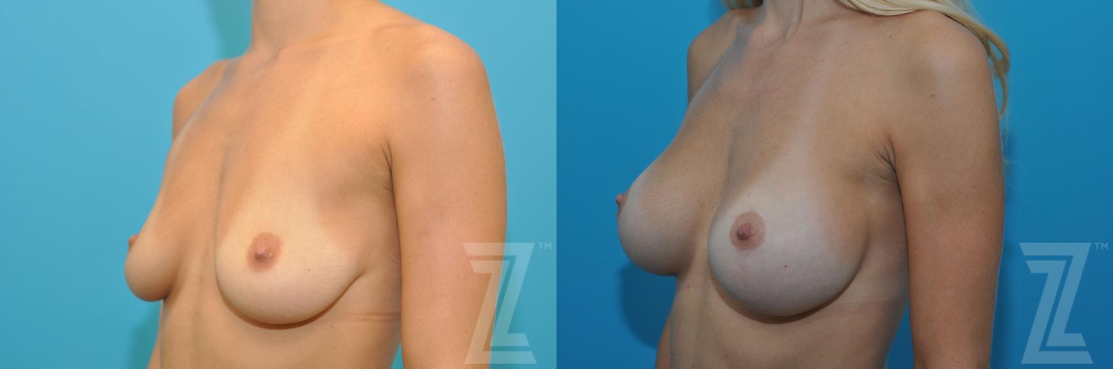 Austin Breast Augmentation With a Breast Lift Before & After Gallery - Patient 132791105 - Image 2 - The Piazza Center
