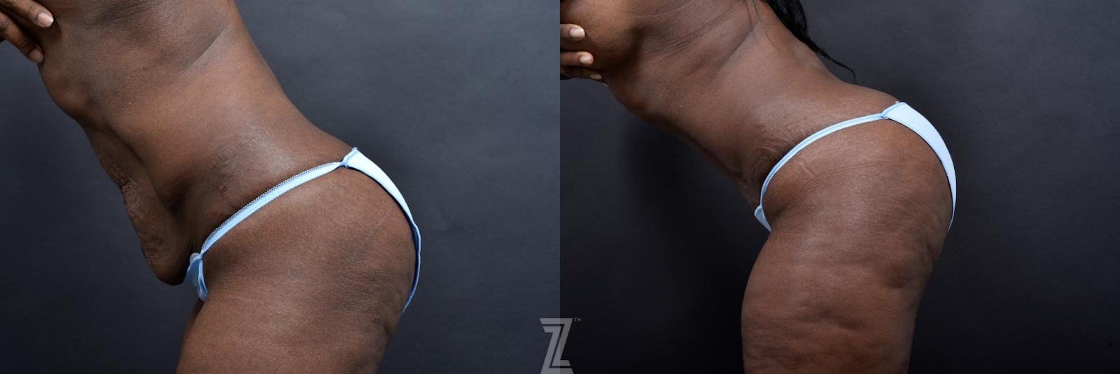 Austin Lateral Abdomen View in Flexion 1 Year Post-OP Mommy Makeover in Austin, TX by Dr. Rocco Piazza - The Piazza Center