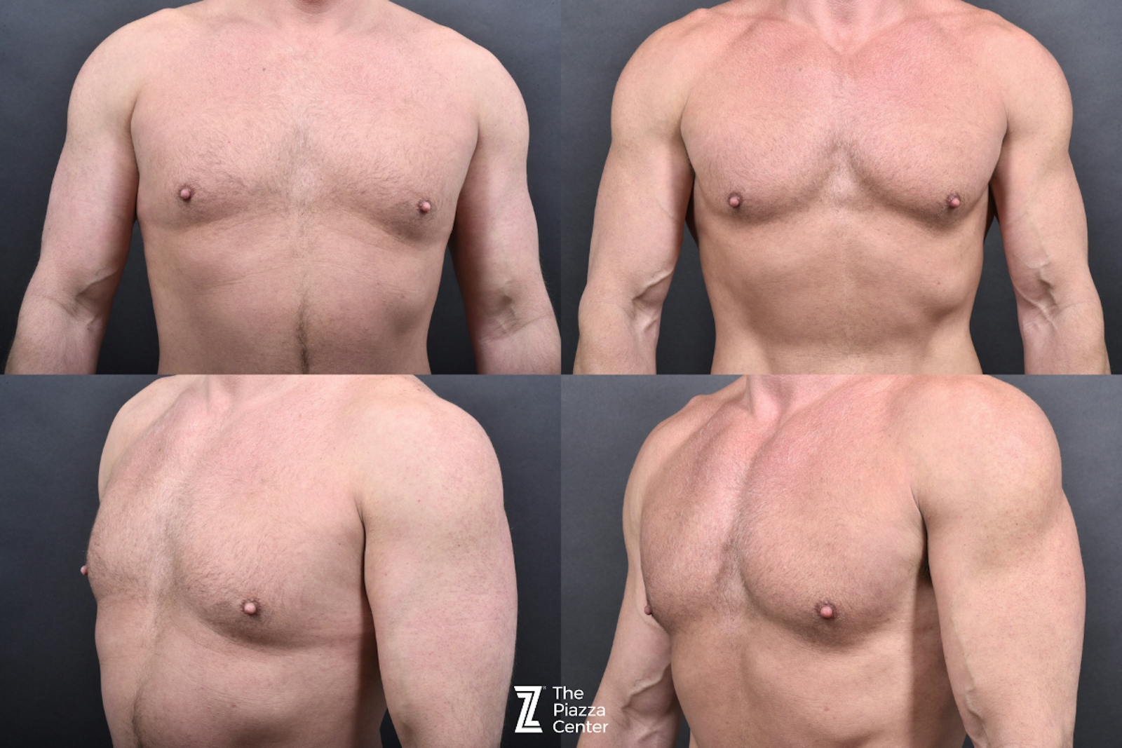 Austin Male Body Contouring Before & After Gallery - Patient 219361 - Image 7 - The Piazza Center