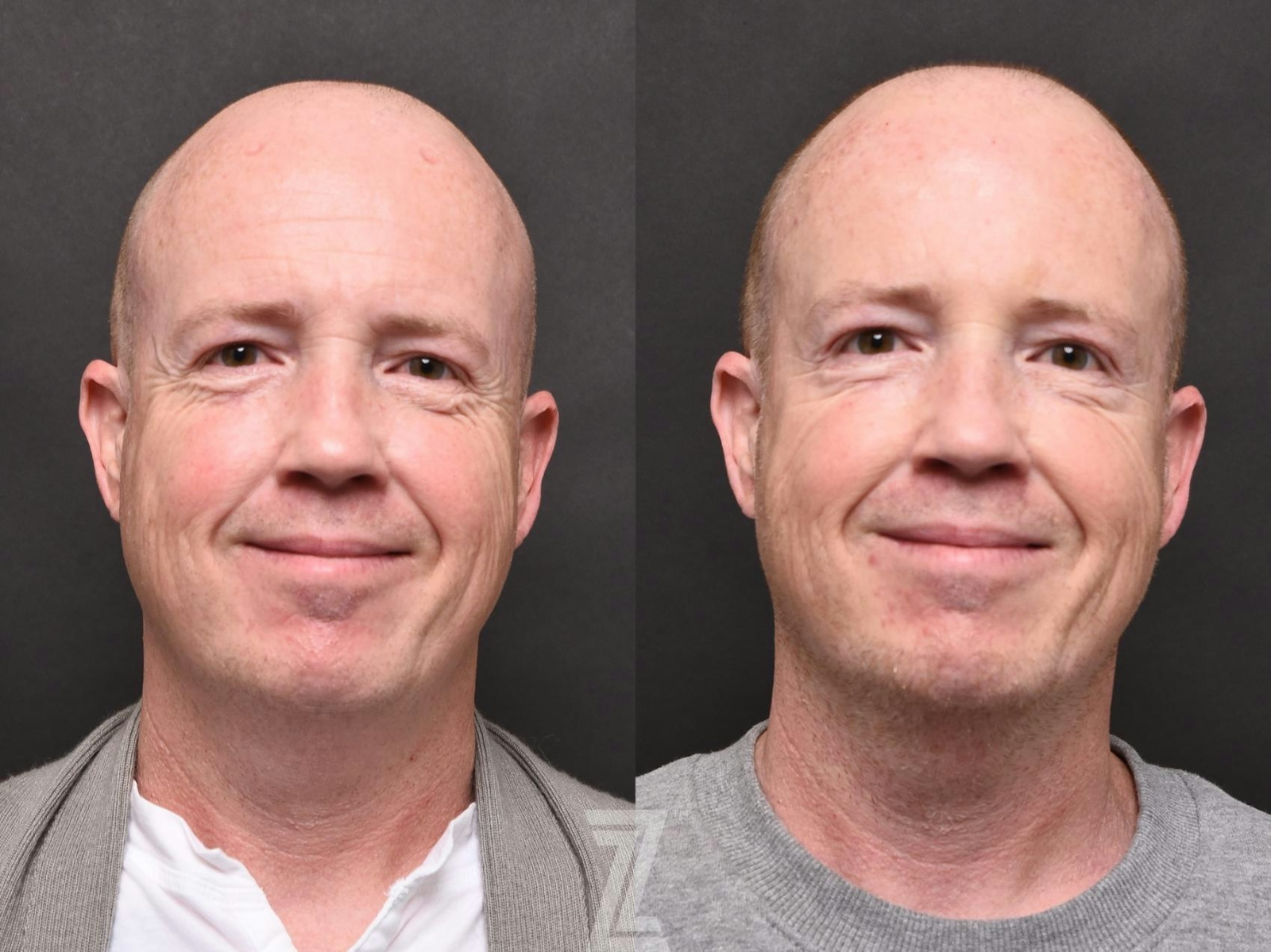 Austin Wrinkle Relaxers Before & After Gallery - Patient 132906313 - Image 3 - The Piazza Center