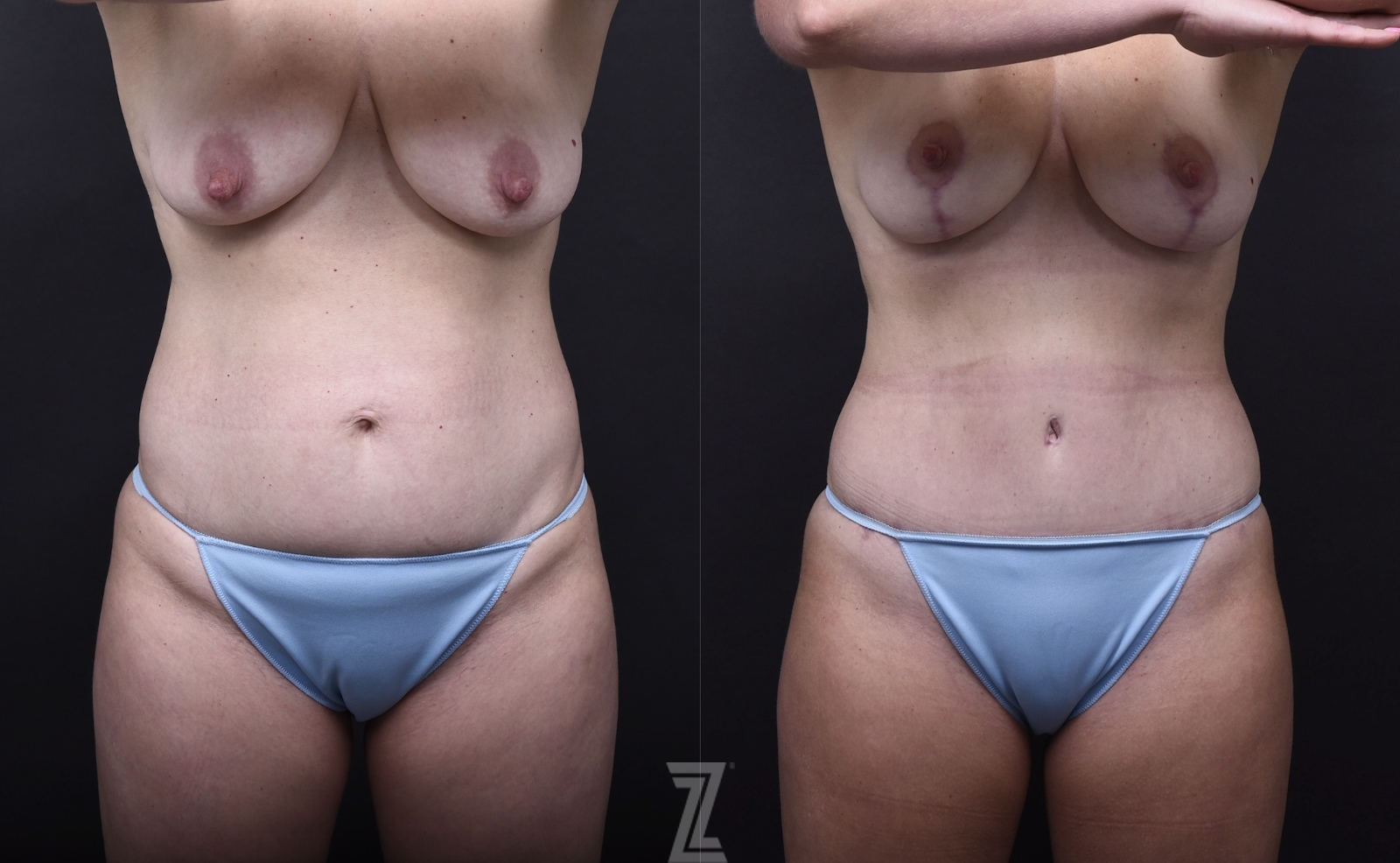 Austin Tummy Tuck Before & After Gallery - Patient 169865 - Image 1 - The Piazza Center