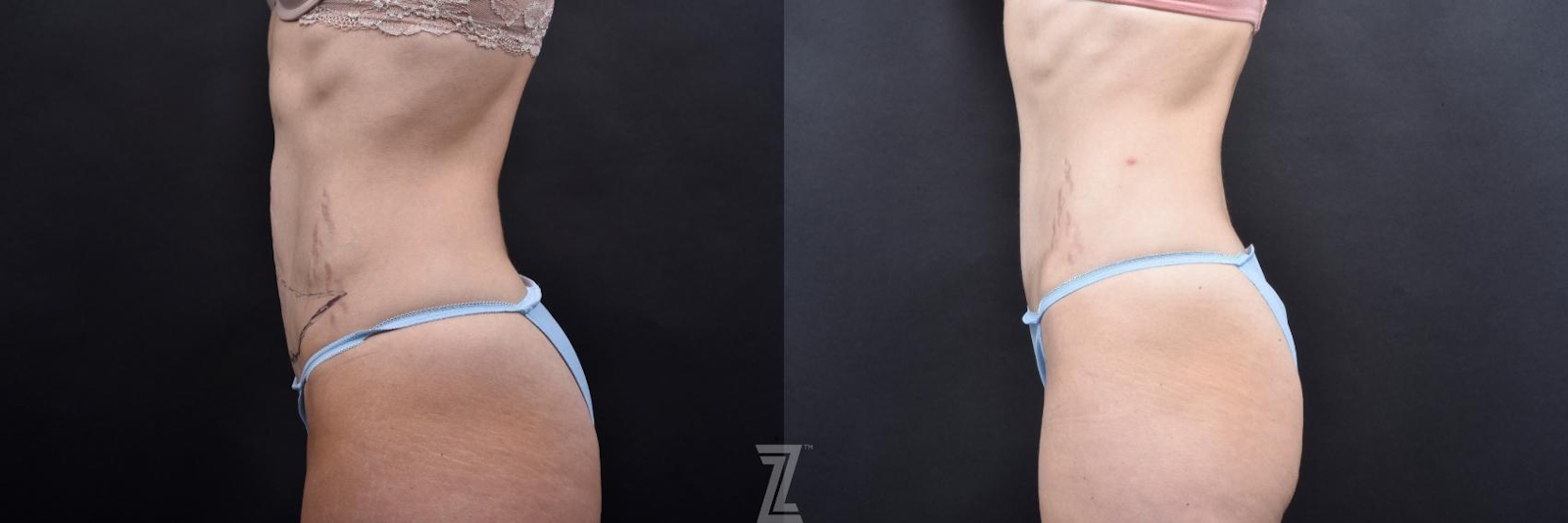 Austin Tummy Tuck Before & After Gallery - Patient 132886798 - Image 2 - The Piazza Center