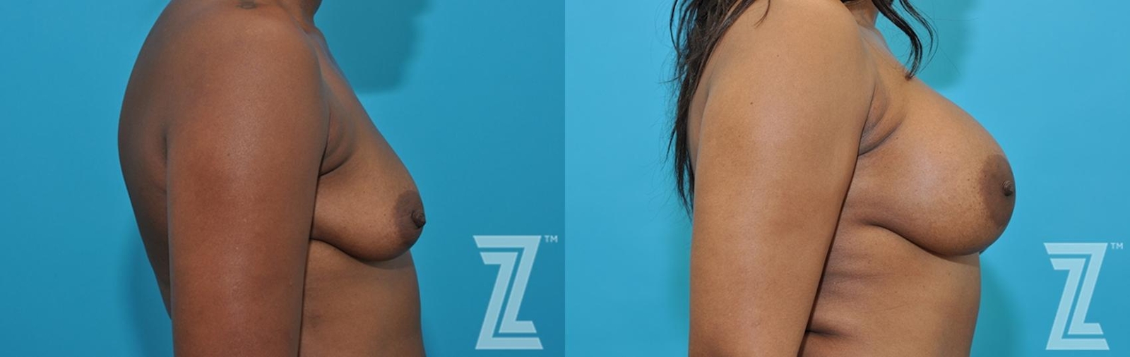 Austin Side breast view of 43-year-old mother of two mommy maker over - Dr. Rocco Piazza - The Piazza Center
