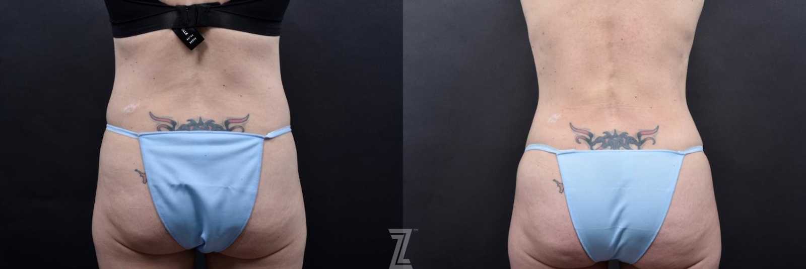Austin Tummy Tuck Before & After Gallery - Patient 132886820 - Image 6 - The Piazza Center