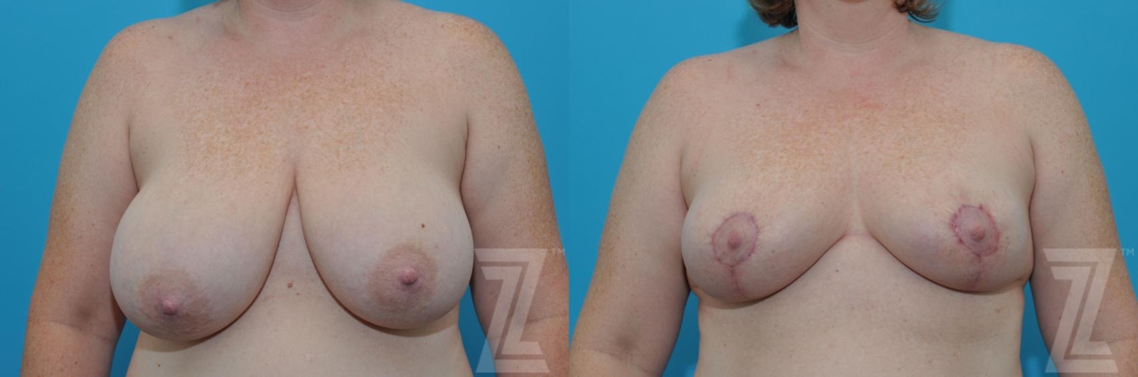 Austin Breast Reduction Before & After Gallery - Patient 132886606 - Image 1 - The Piazza Center
