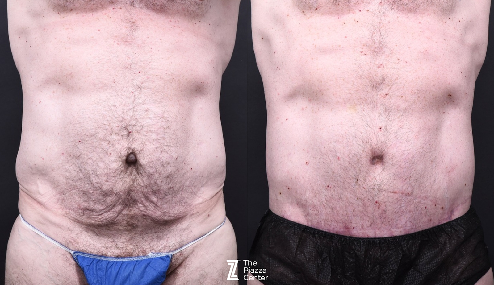 Austin Tummy Tuck Before & After Gallery - Patient 220707 - Image 1 - The Piazza Center