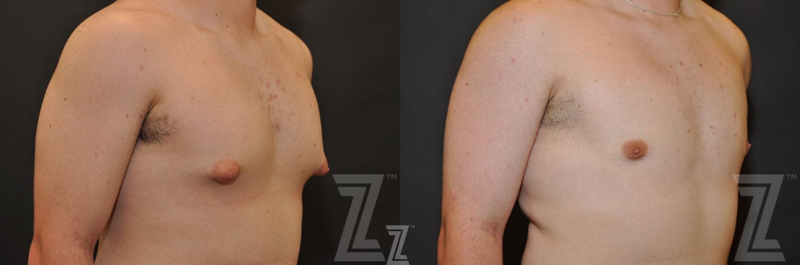 Austin Gynecomastia/Male Breast Reduction Before & After Gallery - Patient 871481 - Image 3 - The Piazza Center