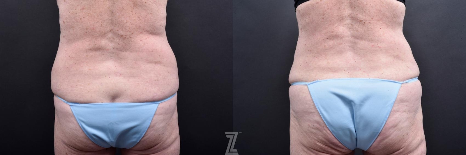 Austin Tummy Tuck Before & After Gallery - Patient 132886796 - Image 4 - The Piazza Center