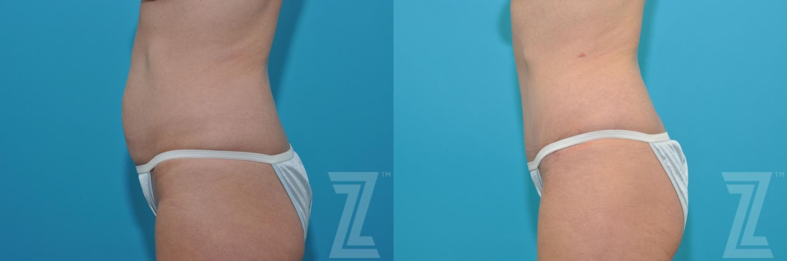 Austin Tummy Tuck Before & After Gallery - Patient 132886905 - Image 2 - The Piazza Center