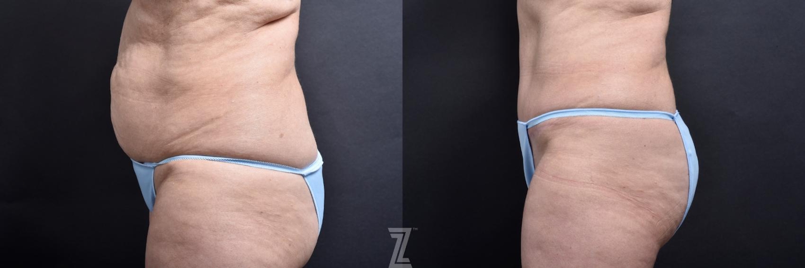 Austin Tummy Tuck Before & After Gallery - Patient 132886818 - Image 3 - The Piazza Center
