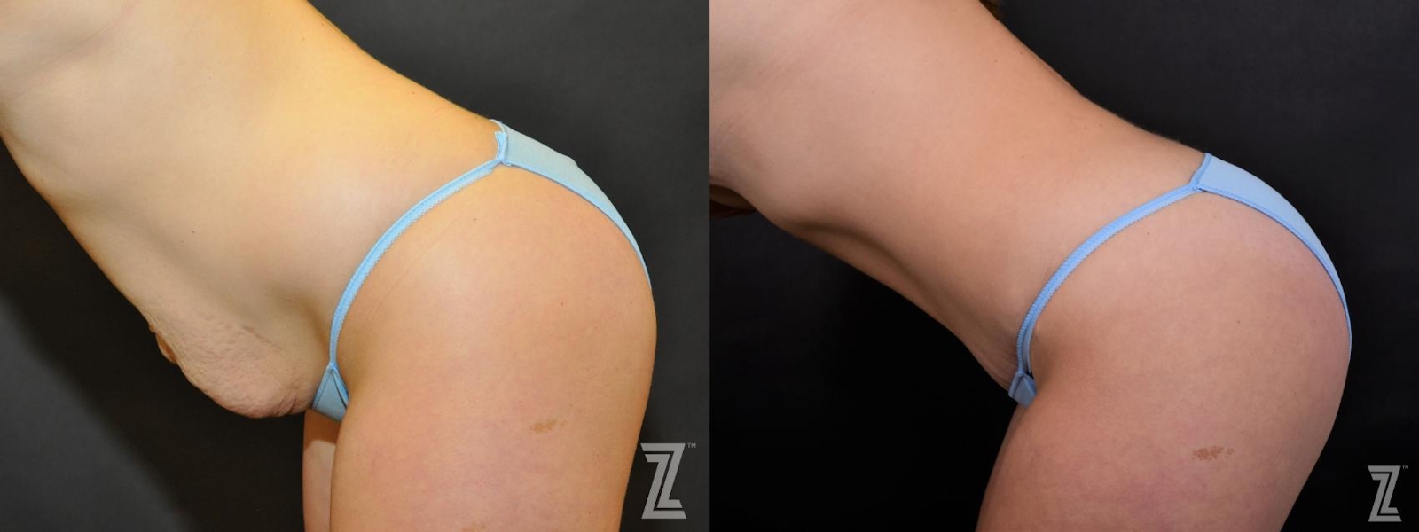 Austin Tummy Tuck Before & After Gallery - Patient 132886895 - Image 3 - The Piazza Center
