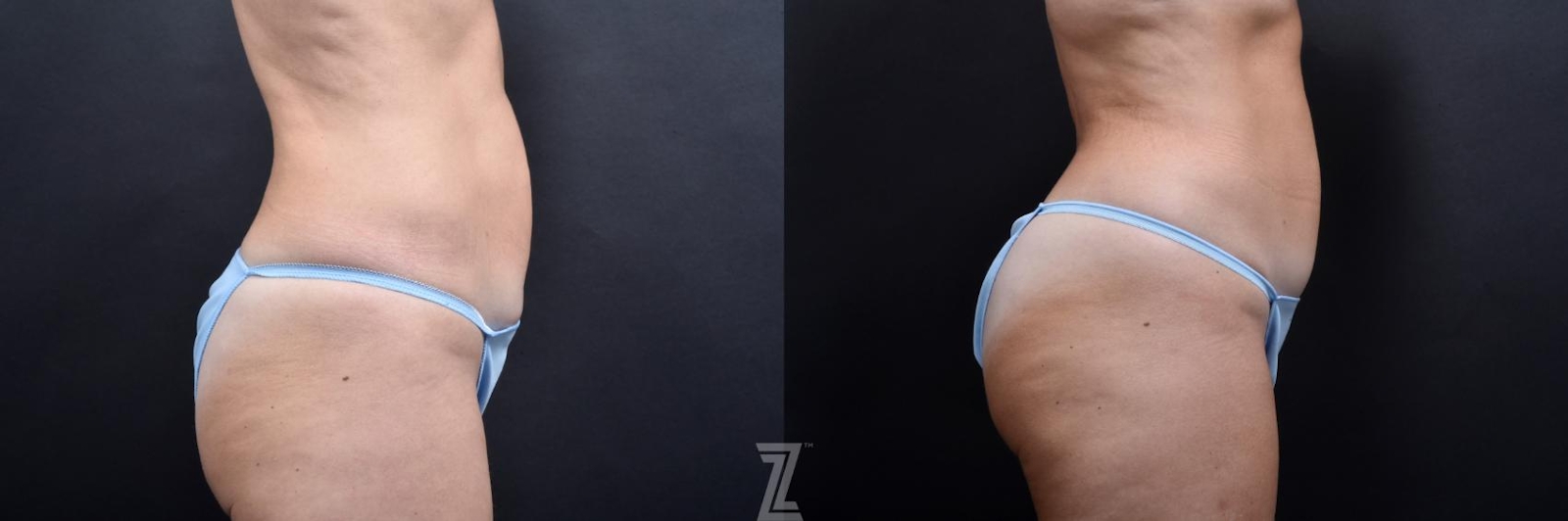 Austin Skin Pinch Before & After Gallery - Patient 132886939 - Image 4 - The Piazza Center