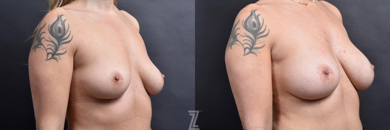 Austin Oblique 6 month post op before and after image of 39 year old woman with Silicone Implants with Cohesive Silicone Gel - The Piazza Center