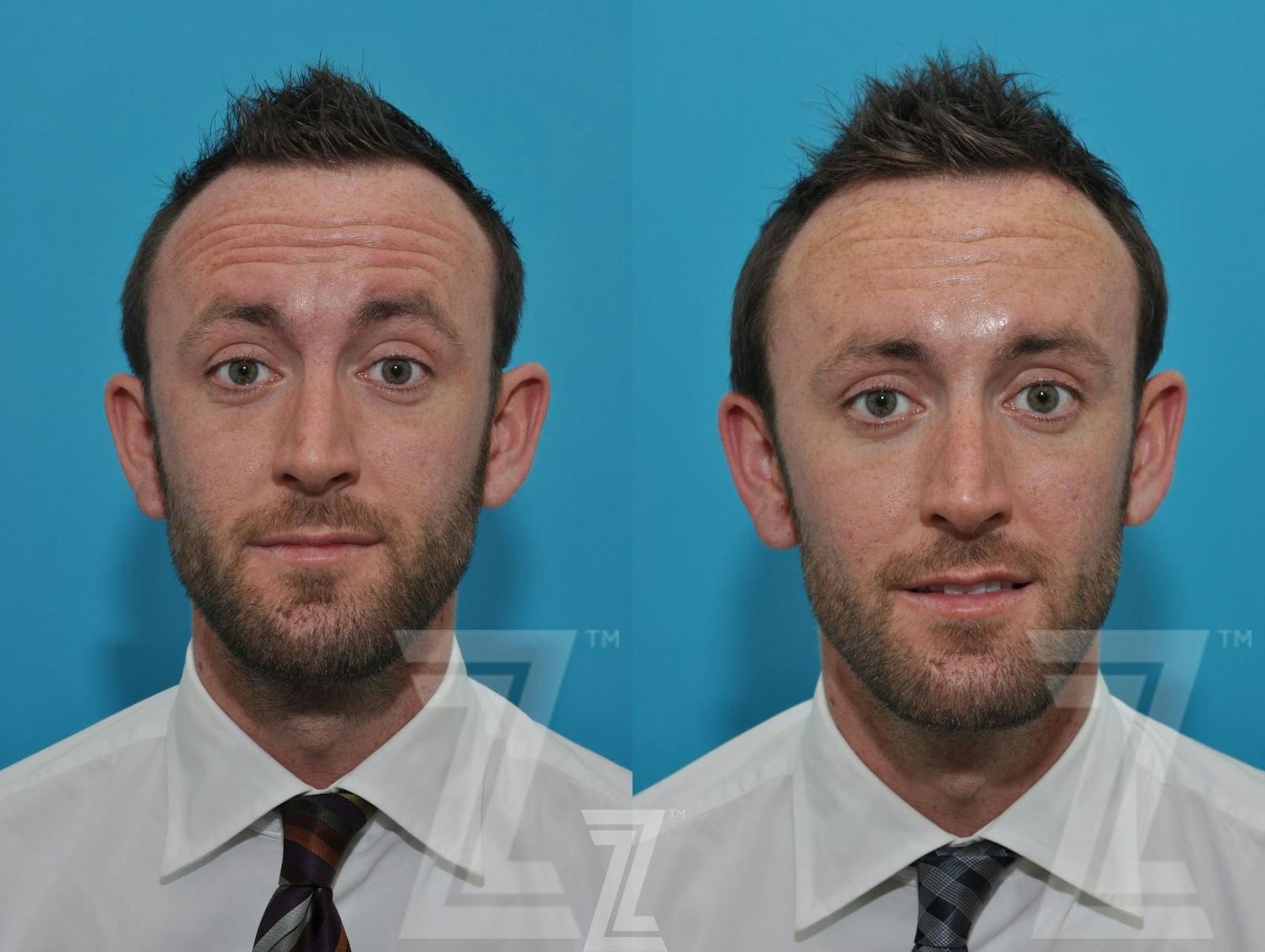 Austin Male Injectables Before & After Gallery - Patient 106343 - Image 3 - The Piazza Center