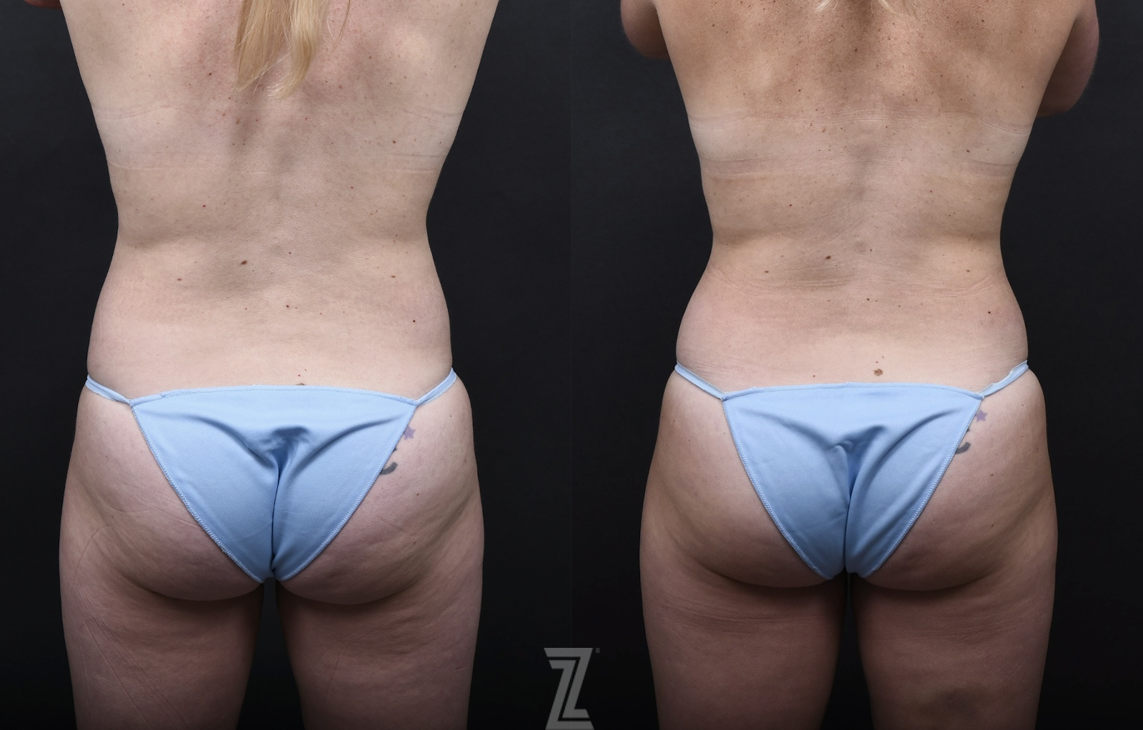 Austin Tummy Tuck Before & After Gallery - Patient 169865 - Image 6 - The Piazza Center