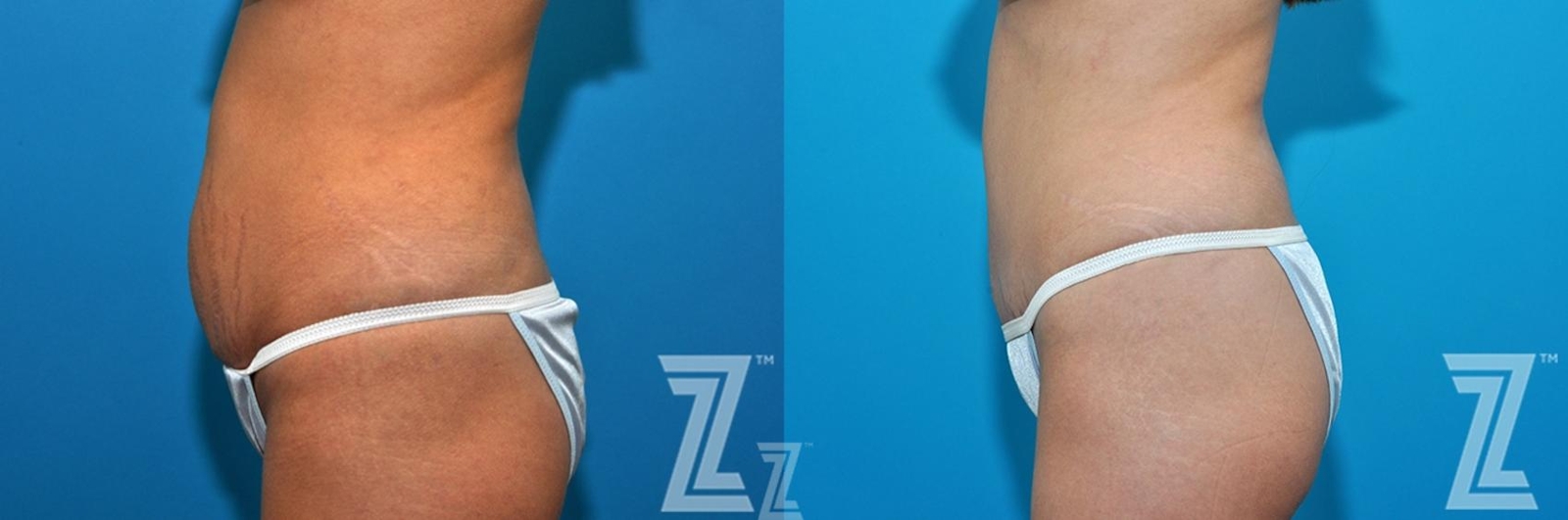 Austin 36 year old woman 1 year post op side abdominal view mommy makeover - Austin Tx, The Piazza Center - The Piazza Center