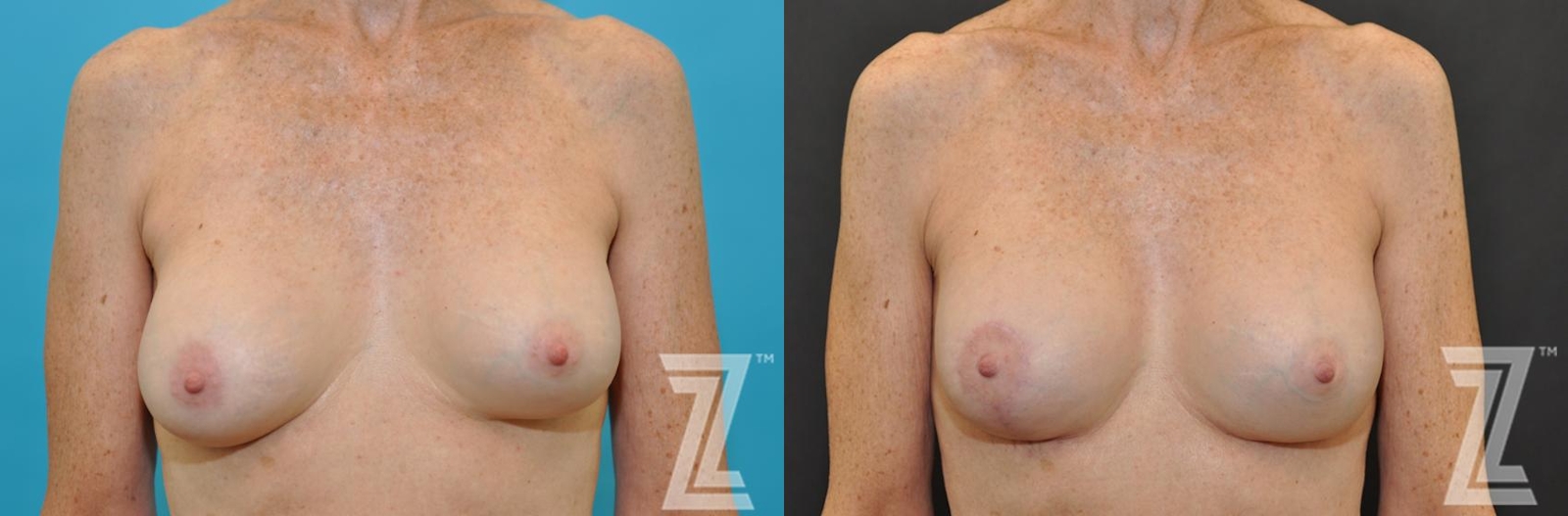 Austin Breast Augmentation Revision Before & After Gallery - Patient 132793347 - Image 1 - The Piazza Center