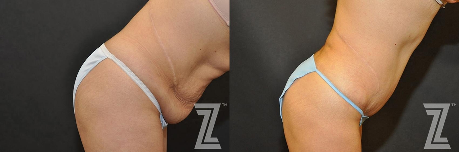 Austin Tummy Tuck Before & After Gallery - Patient 132886902 - Image 6 - The Piazza Center