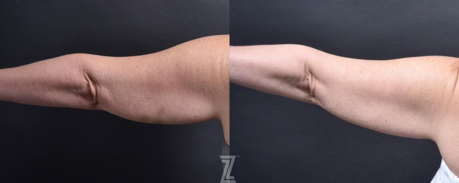 Austin Profound® RF Microneedling Before & After Gallery - Patient 132963577 - Image 2 - The Piazza Center