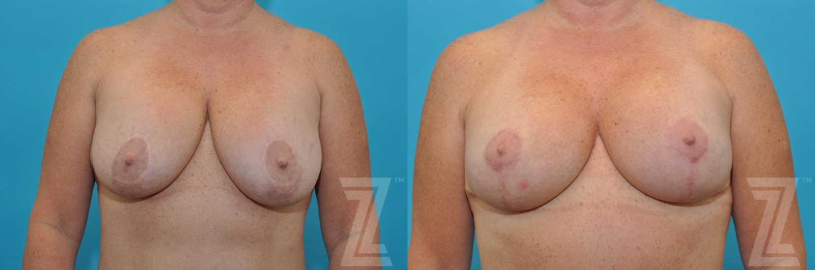 Austin Breast Augmentation Revision Before & After Gallery - Patient 132886540 - Image 1 - The Piazza Center