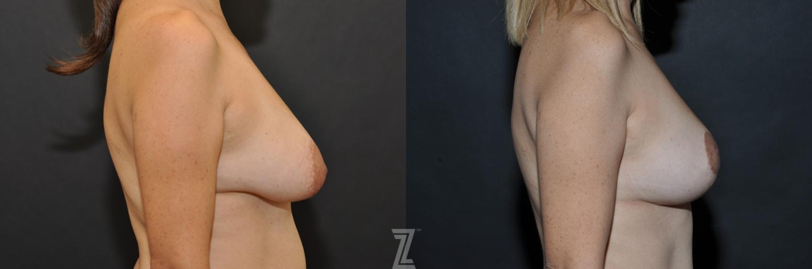 Austin Breast Reduction Before & After Gallery - Patient 132886614 - Image 5 - The Piazza Center