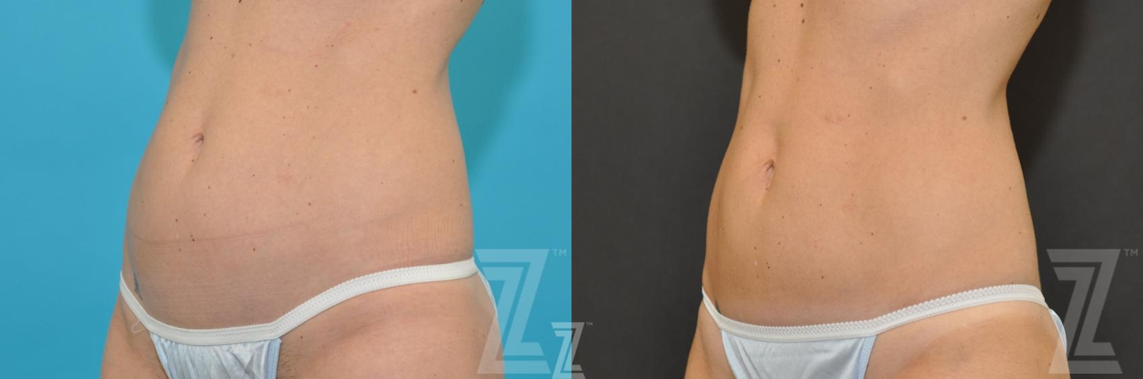 Austin CoolSculpting® Before & After Gallery - Patient 132905384 - Image 1 - The Piazza Center