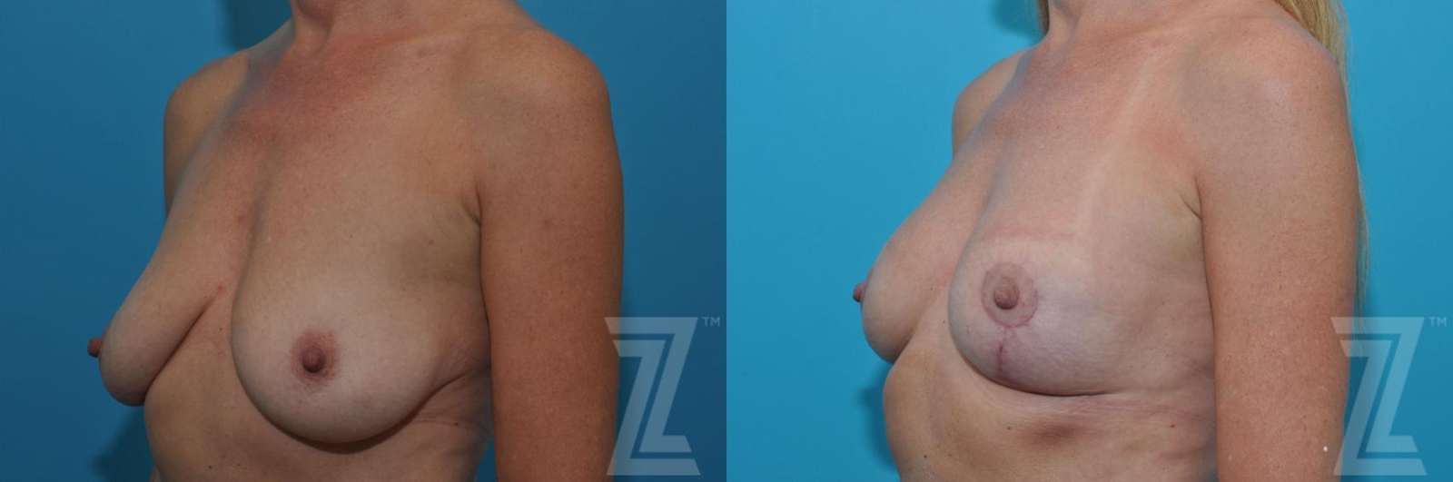Austin Breast Lift Before & After Gallery - Patient 132791081 - Image 2 - The Piazza Center