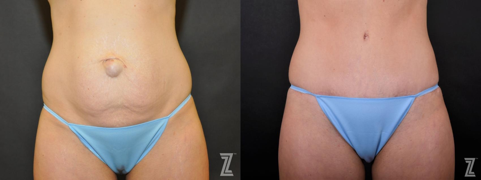 Austin Tummy Tuck Before & After Gallery - Patient 132886895 - Image 1 - The Piazza Center