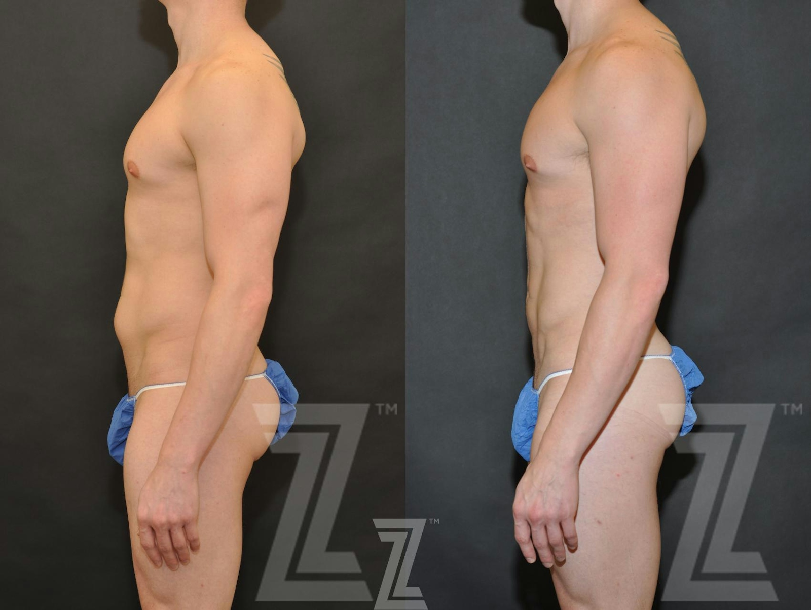 Austin Male Body Contouring Before & After Gallery - Patient 174118 - Image 3 - The Piazza Center
