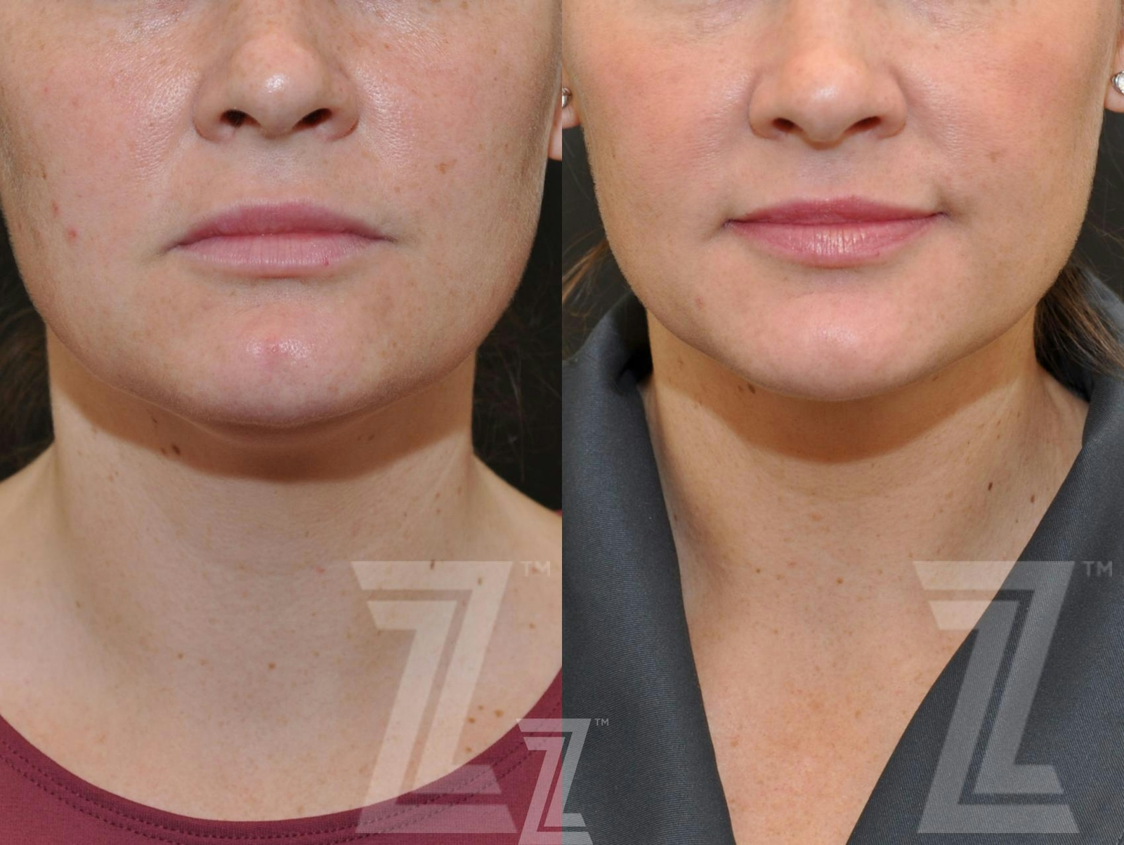 Austin KYBELLA® Before & After Gallery - Patient 132963129 - Image 2 - The Piazza Center