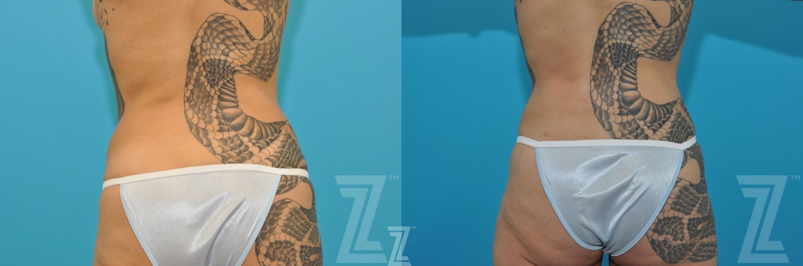 Austin Tummy Tuck Before & After Gallery - Patient 377913 - Image 6 - The Piazza Center