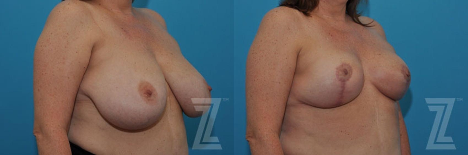 Austin Breast Reduction Before & After Gallery - Patient 132886747 - Image 4 - The Piazza Center