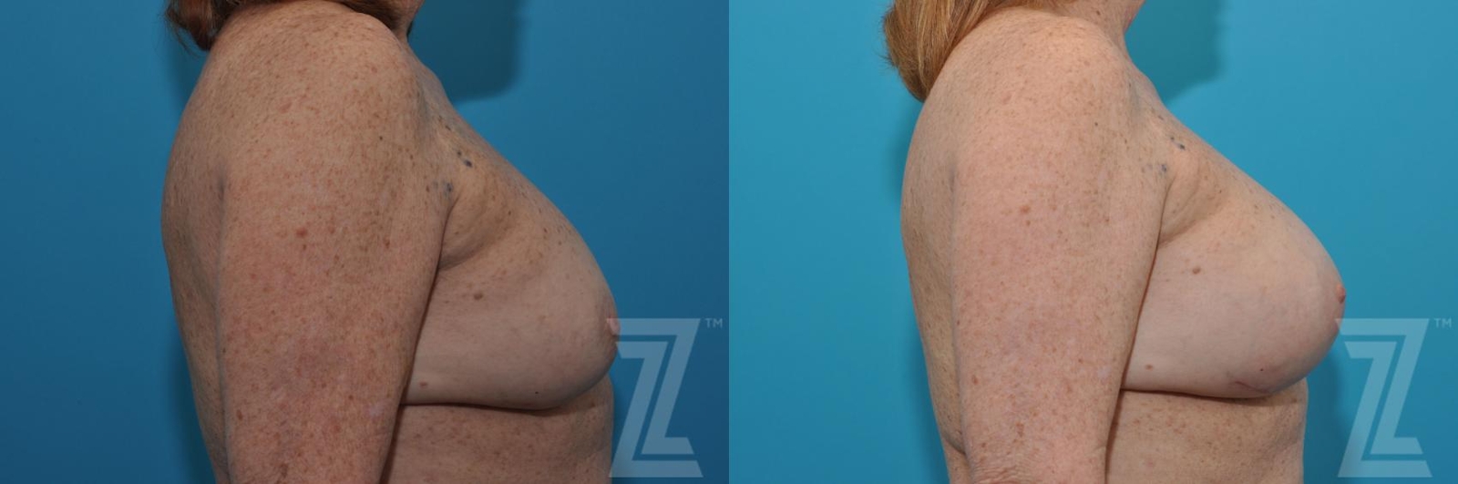 Austin Breast Augmentation Revision Before & After Gallery - Patient 132886549 - Image 5 - The Piazza Center