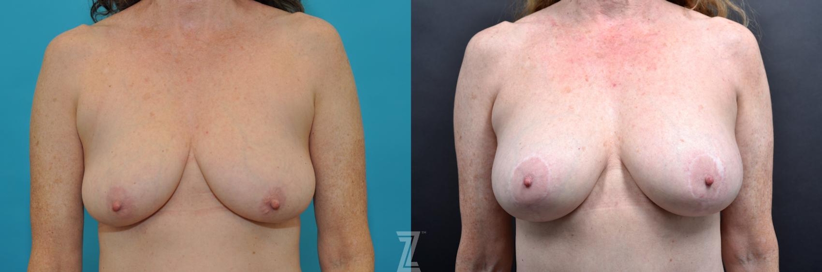 Austin Frontal Breast view 7 year post op mommy makeover - The Piazza Center, Austin Tx - The Piazza Center
