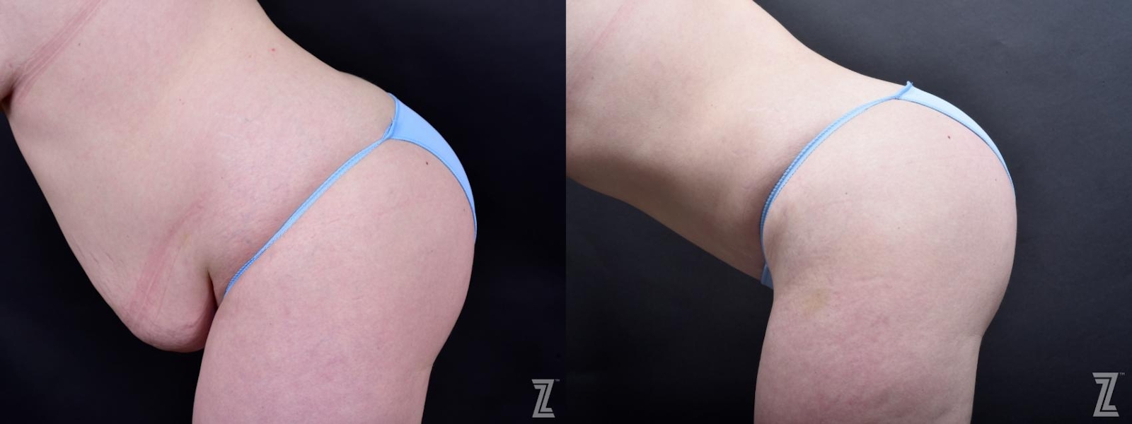 Austin Tummy Tuck Before & After Gallery - Patient 132886803 - Image 3 - The Piazza Center