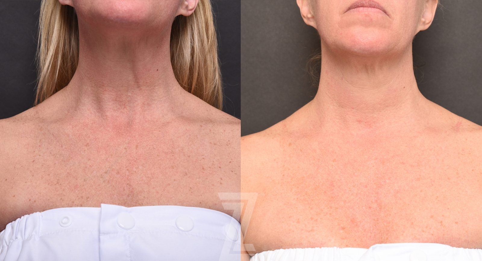 Austin BBL Before & After Gallery - Patient 138650 - Image 1 - The Piazza Center