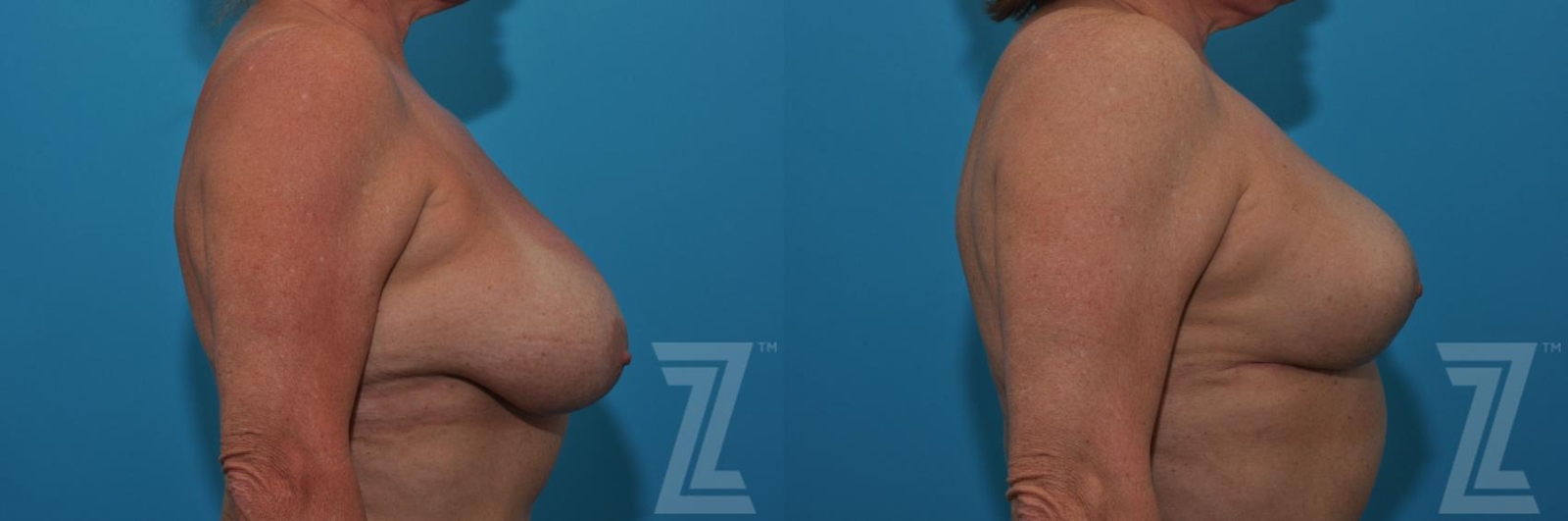 Austin Breast Lift Before & After Gallery - Patient 132791080 - Image 5 - The Piazza Center