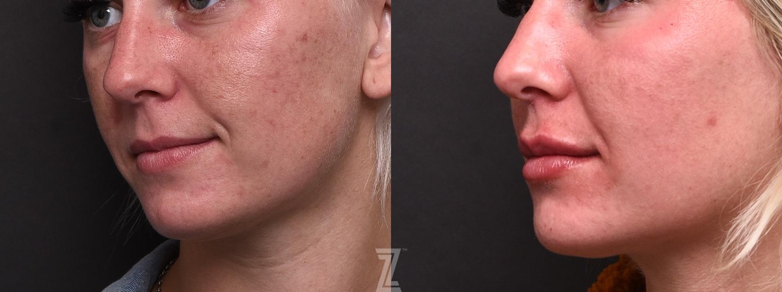 Austin Injectable Fillers Before & After Gallery - Patient 132963106 - Image 2 - The Piazza Center