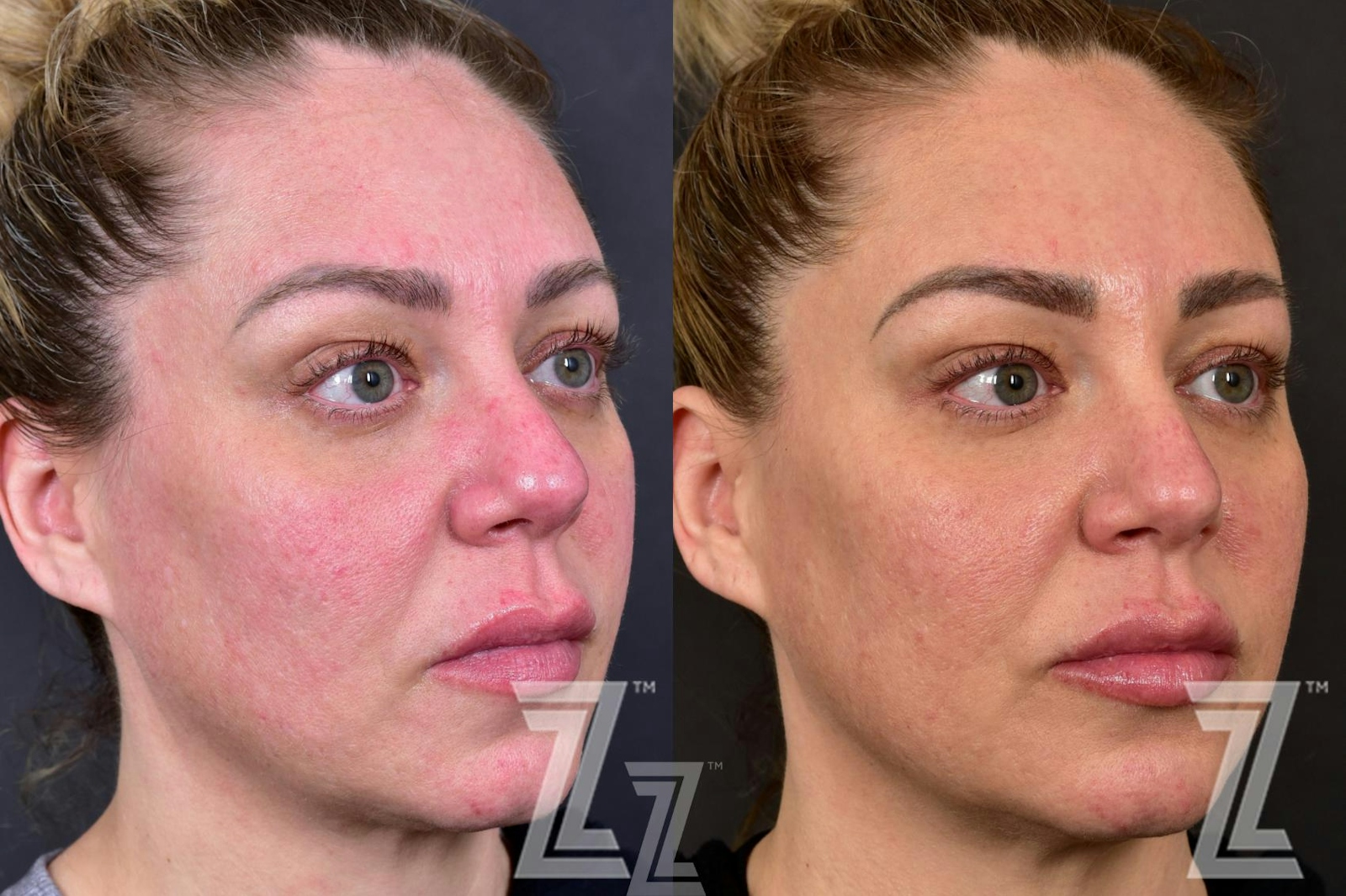 Austin BBL Before & After Gallery - Patient 132963256 - Image 3 - The Piazza Center