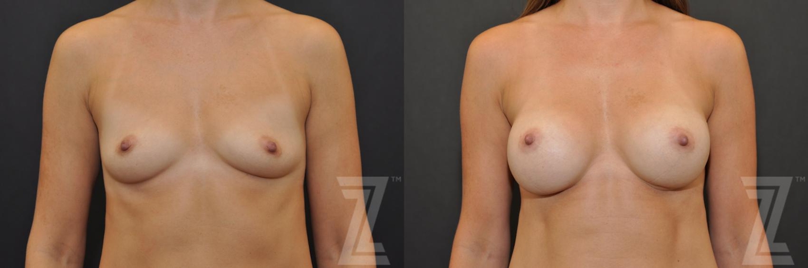 Austin Frontal view before & after images of 32-year-old mother of two 6 month post op breast augmentation - The Piazza Center - The Piazza Center
