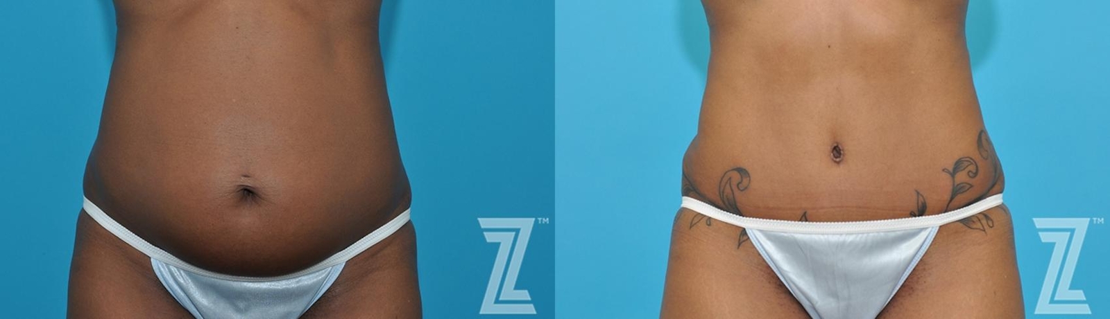 Austin Frontal Lower Abdomen view of 43-year-old mother of two mommy maker over - Dr. Rocco Piazza - The Piazza Center